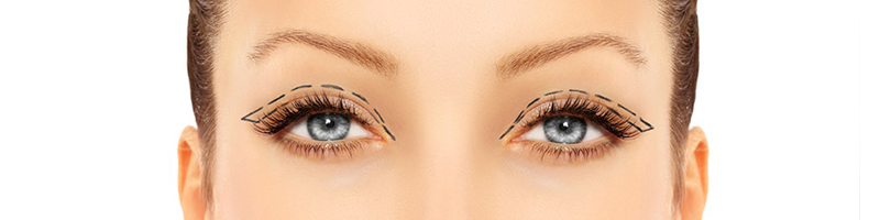 blepharoplasty