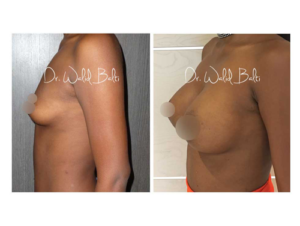 breast augmentation