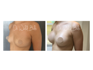 breast augmentation