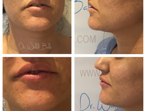 Lip augmentation