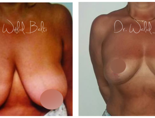 Breast reduction