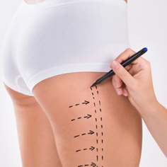 liposuction