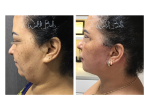 face liposuction