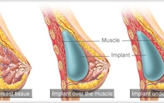 breast implants positions tunisia