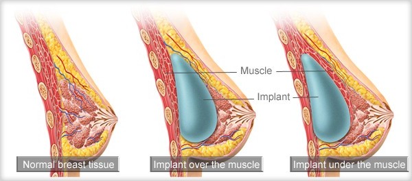 breast implants positions tunisia