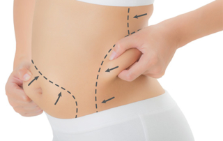 liposuction