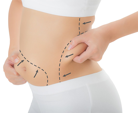 liposuction