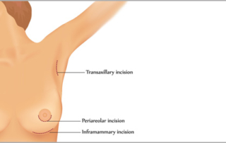 breast augmentation incisions tunisia
