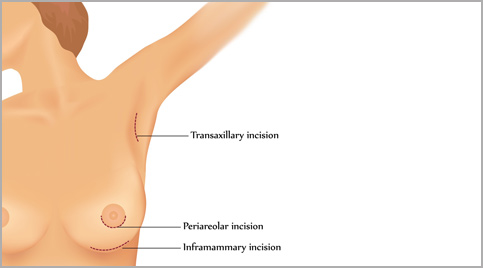 breast augmentation incisions tunisia