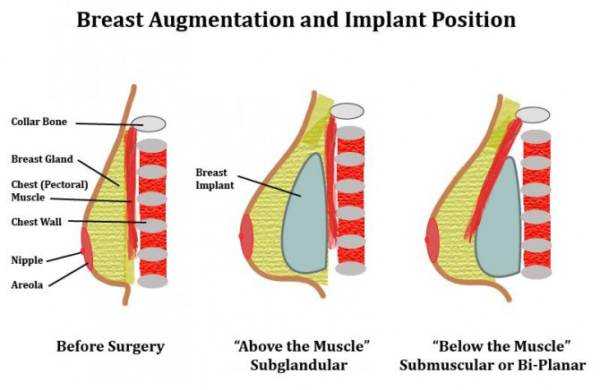 positions breast implants