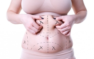 abdominoplasty tunis