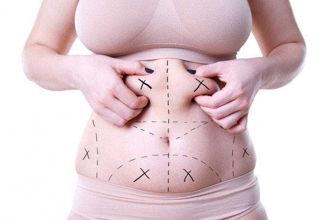 abdominoplasty tunis