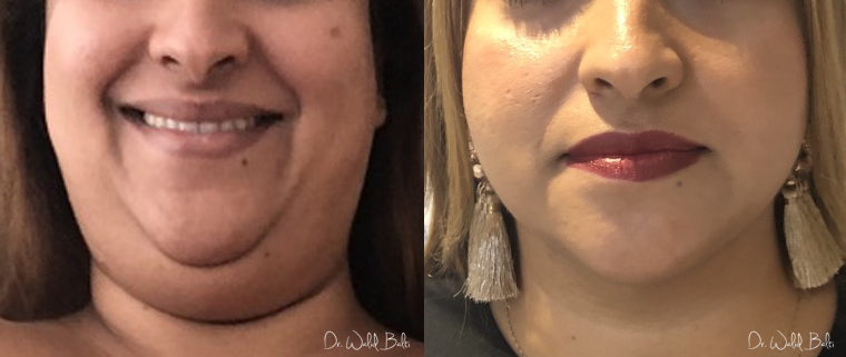 neck chin liposuction