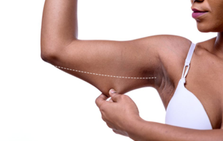 arm lift