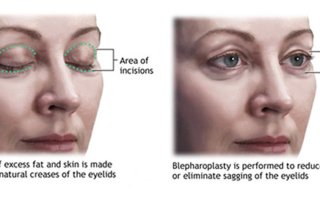 eyelid surgery tunis