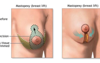 breast lift mastopexy