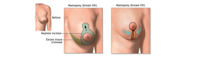 breast lift mastopexy