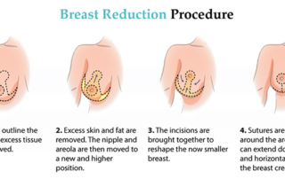 breast reduction tunisia