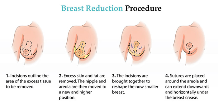 Breast Reduction  1 week post op update! 