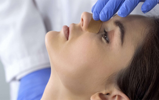rhinoplasty