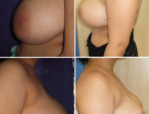 Breast reduction