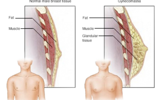 Gynecomastia surgery
