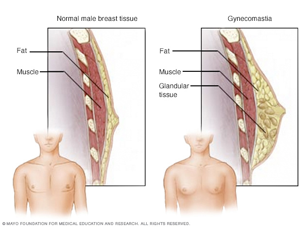 Gynecomastia surgery