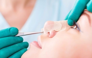 Rhinoplasty