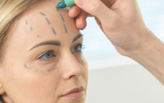 facelift after 10years