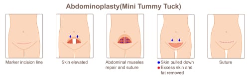 mini tummy tuck tunisia