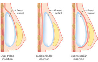 breast implant placement