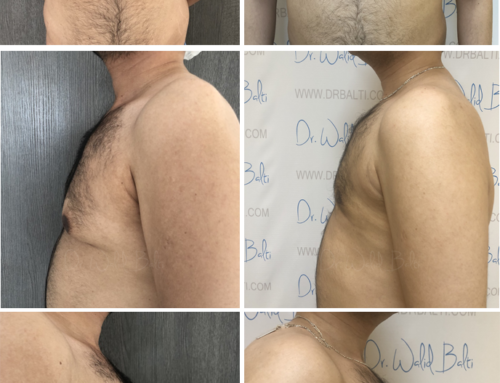 Gynecomastia