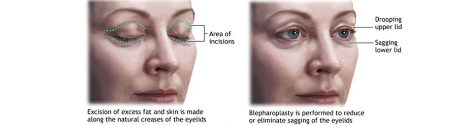 eyelid surgery