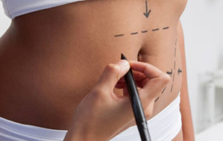 tummy tuck