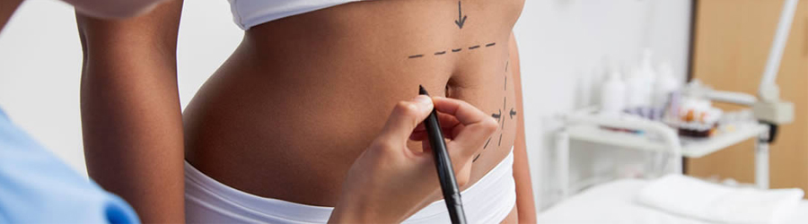 tummy tuck