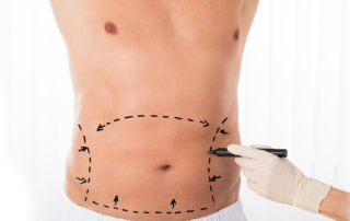 abdominoplasty tunisia