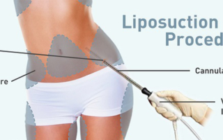 liposuction