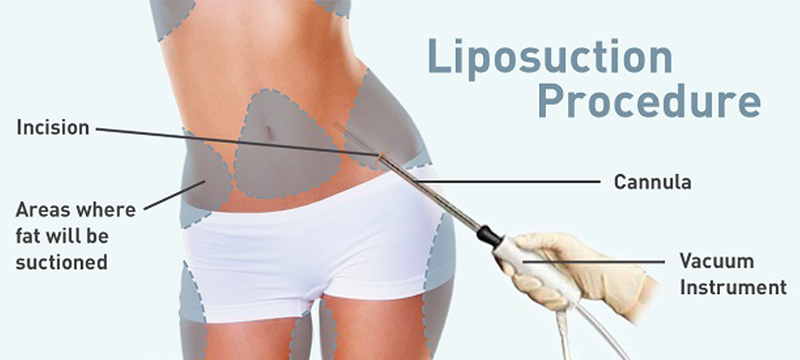 liposuction