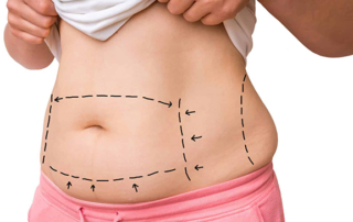 tummy tuck surgery tunisia