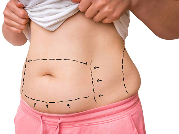 tummy tuck surgery tunisia