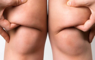 Fat Knees treatment tunisia