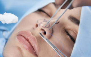 rhinoplasty tunisia