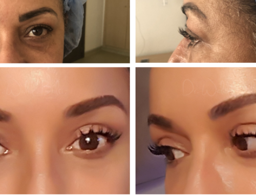 Upper eyelid lift