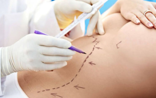 liposuction surgery tunisia