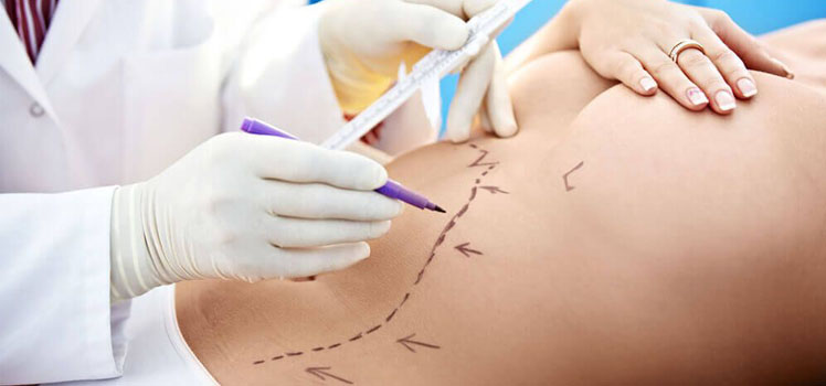 liposuction surgery tunisia