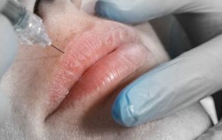 Hyaluronic acid : applications in facial anti-aging