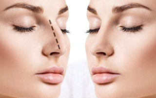 about rhinoplasty before consulting a surgeon