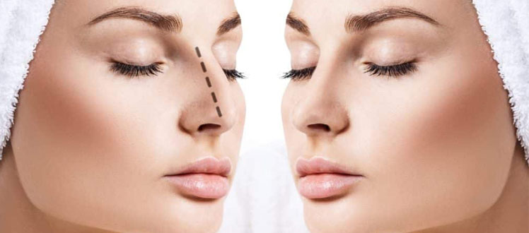 about rhinoplasty before consulting a surgeon