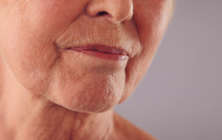 Skin slackening or sagging