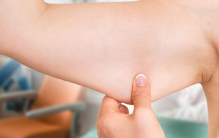 Treating sagging upper arms tunisia